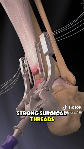 Achilles Tendon Repair Surgery Explained