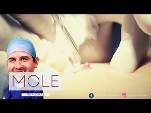Mole Removal on Back - Raised Mole