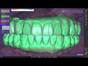 Exocad Alignment – iMetric iCAM4D