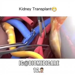 31 reactions | #kidney #transplantation A kidney transplant is a surgical procedure to place a healthy kidney from a living or deceased donor into a person whose kidneys no longer function properly. The kidneys are two bean-shaped organs located on each side of the spine just below the rib cage. Each is about the size of a fist Follow for more ♥️ #medicalstudent #anatomy #muscles #learning #medicine #abdominalmuscles #drawing #drawing #study | Medical Knowledge | Facebook