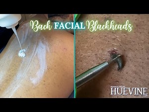 The Back Facial With A Blackened Cyst - Treat Your Bacne, Part 1 | HueVine