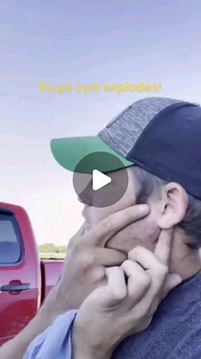 Pimple Popping on Instagram: "Omg 🙄🙄🙄 - - #pimplepoppingvideos #whiteheadsextraction #cystremoval #cyst #extraction #zit #zitpopper #pimplelifechoseme #pimpleproblems"