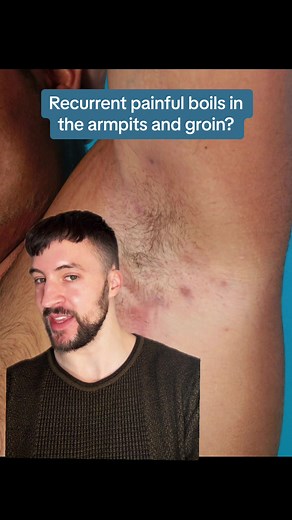 Do you get recurrent painful boils in the armpits or groin? You may have this underdiagnosed skin condition! #hs #hidradenitis #hidradenitissuppurativa
