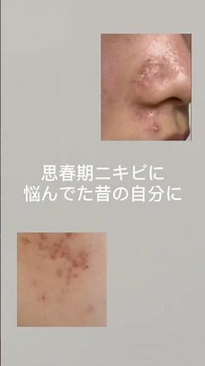 思春期ニキビ撃退クリーム💥