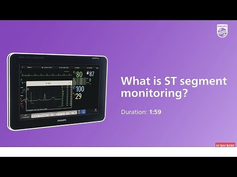 What is ST segments monitoring?