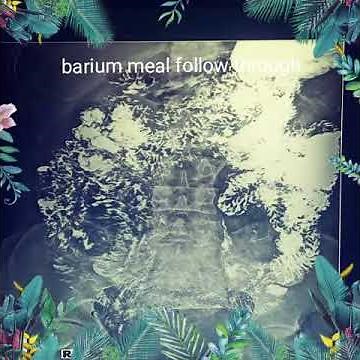 X-ray barium meal follow through procedure