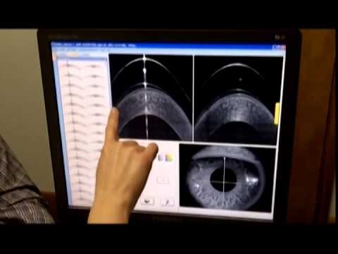 Optovue SD Oct Scleral Lenses Protocol