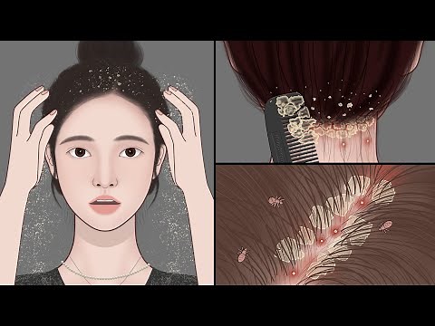 ASMR Big Flakes Dandruff & Head Lice Removal | Satisfying Scalp Treatment | Meng’s Stop Motion