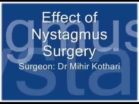 Effects/Results of a Nystagmus surgery