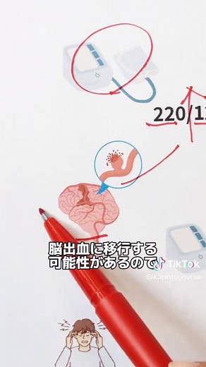 脳梗塞時の血圧コントロール方法