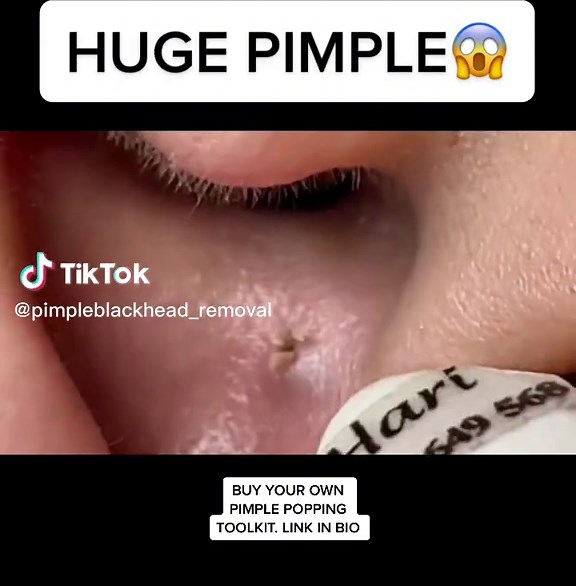 PIMPLE POPS on face. LINK IN BIO to buy your own pimple popping toolkit. #acne #antiaging #acnetreatment #blackheadremoval #blackhead #blackheads #blackheadextraction #facialathome #cyst #clearskin #dermaplaning#drpimplepopper #dermaplane #drsandralee#glowingskin #oilyskin #pimple #pimplepopper#pimpleproblems #pimplepopping #pimplepoppers #skincare #naturalskin #sivilcesikma #zits #skinhealth #skincaretipsWe are rewarded by our partners for the products we promote.
