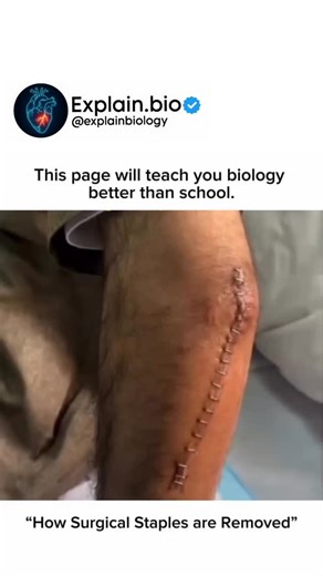 BIOLOGY | MEDICAL | HEALTH on Instagram: "Surgical staples are typically removed 7-14 days post-op using a special staple remover tool that painlessly slides under the staple center, allowing it to be lifted out without opening the wound. Follow for more @explain.bio #Surgery #medical #nurse"