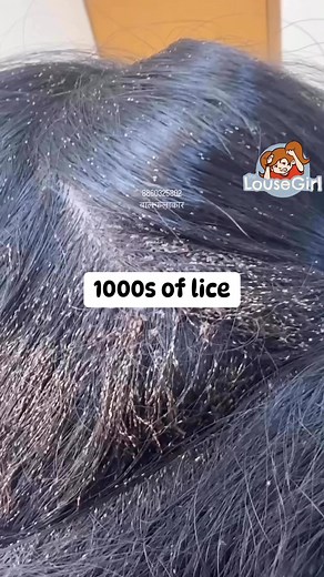310K views · 807 reactions | Severe lice infestation l 1000s of lice #momlife #hair #school #piojos #explore | Lousy Stacey | Facebook