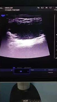 Subcutaneous abscess abdominal wall