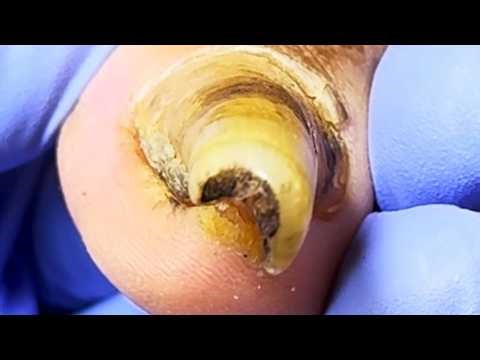 Severely deformed onychomycosis, very hard and hard to trim【Dr. Liu's Pedicur】