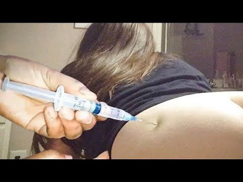 IM Injection in Buttocks (Hip) | Ventrogluteal Injection Technique | Nursing Skills
