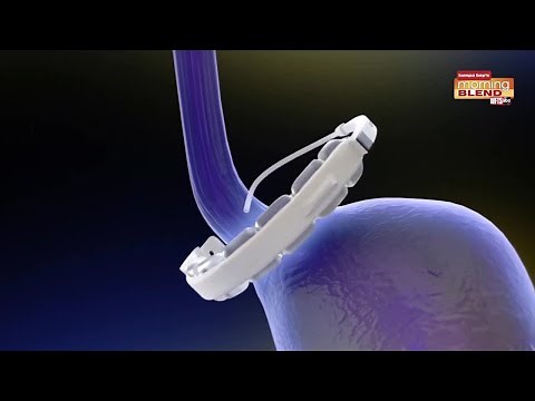 Benefits of Lap Band Surgery | Morning Blend
