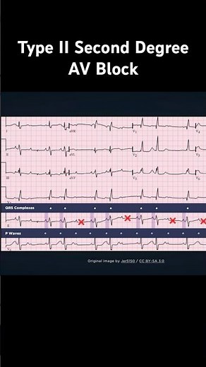 AV Block: 2nd degree, Mobitz II (Hay block)