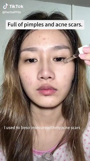 I'm happy, my acne is gone#SADOER #exfoliation #sleepmasque #pimple #skincleansing