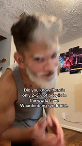 5.6K views · 1.2K reactions | Waardenburg syndrome is a rare genetic disorder characterized by distinct pigmentation changes, including bright blue eyes or heterochromia, and patchy depigmentation of the skin or hair resembling vitiligo. The condition may also be associated with varying degrees of hearing loss. #waardenburgsyndrome #waardenburg #unique #rare #deaf | Faizy Legend | Facebook