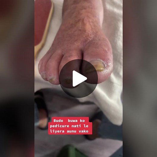 Effective Pedicure Tips for Fungal Nail Treatment