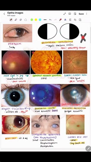 Ophthalmology All Important Images For FMGE and NEETPG Need this pdf drop comment "Image's" | Medicalguideliner