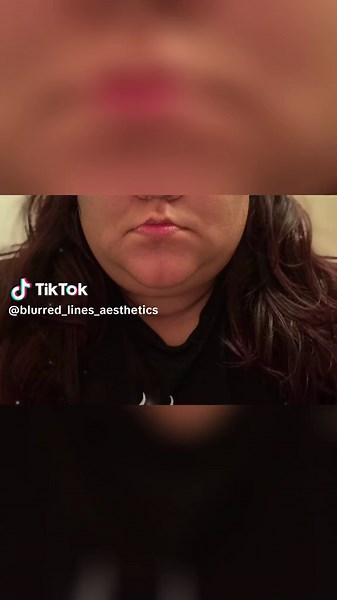 Transform Your Submental Area with PCDC Treatment