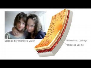 Anti-VEGF Treatment of Diabetic Macular Edema (DME)