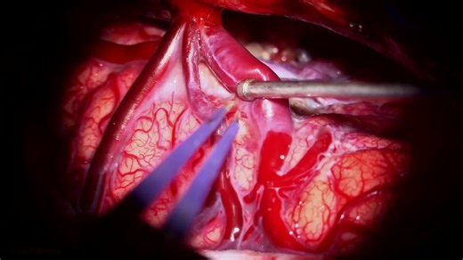 #411: Posterior Interhemispheric Approach for Resection of a Medial Parietal Arteriovenous Malformation - All Videos - Seven Series Collection