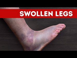 Understanding Leg Swelling: Causes & Solutions