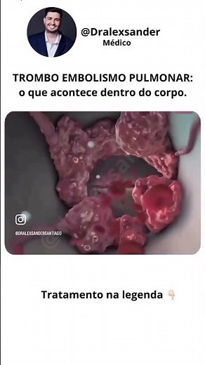 TEP: tratamento prático conforme a gravidade: o que fazer no paciente estável e instável