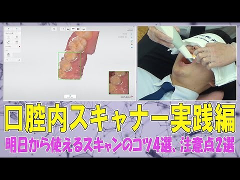 口腔内スキャナー実践編~明日から使えるスキャンのコツ4選、注意点2選~