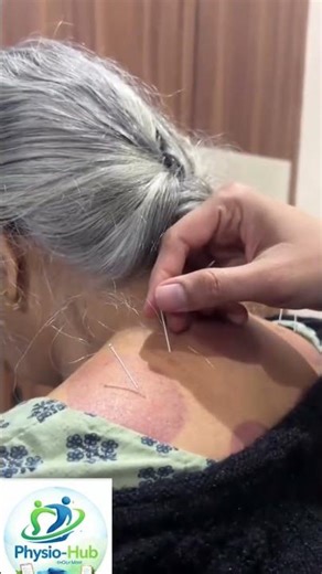 Acupuncture thrapy #viral #youtube