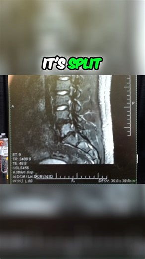 The truth of how long an injured spine can take to fully heal! #spinefacts #lowerbackpain #recovery