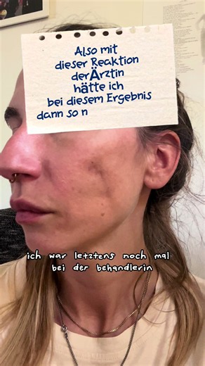 13 Wochen Update. Nach einer Radiesse-Behandlung entstanden bei mir Knubbel unter der Haut. Zur Behandlung wurde Kortison eingesetzt. Die Folge war die sichtbare Einziehung an meiner Wange, die viele von euch inzwischen kennen. Kochsalzlösung hat bisher nichts gebracht. Ich dokumentiere den Verlauf einfach weiter und halte euch auf dem Laufenden. #Radiesse #beauty #filler #kosmetik