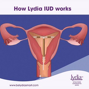 No matter how fast the sperm travels, Lydia IUD works by slowing the speed and movement of sperm so that none can reach the egg. No fertilization. No pregnancy #BeLydiaSmart today! Want to get Lydia IUD? Call Dr Lydia on 09094998788 or Send us a message for referral to the nearest clinic. | Lydia IUD