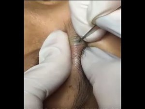 squeeze the cyst on the sore eyebrows to the point of tears