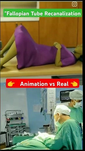 "Fallopian Tube Recanalization: Real Procedure vs Animation | Must Watch! #thelearningfacts#nursing