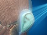 Deformed 'cauliflower' ears could be fixed with simple injection