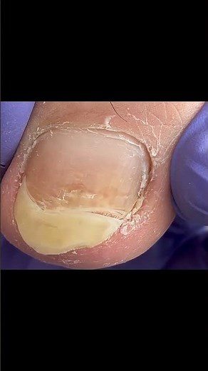 The before & after broke my brain 🤯 #pedicure #toenails #satisfying #nails