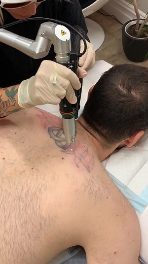 Effective Tribal Tattoo Removal Process in Melbourne