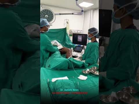 How Varicose Veins are Treated: Laser Ablation & Foam Sclerotherapy Step-by-Step #bloodcirculation