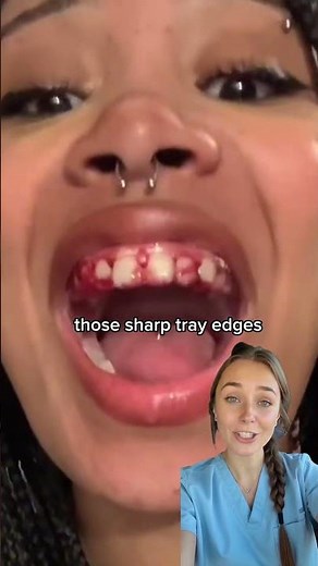 What are invisalign side effects?