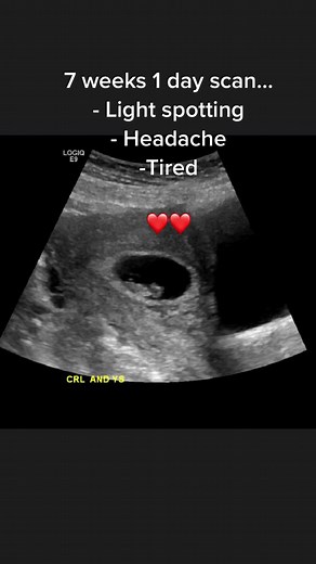 7 Weeks Pregnancy Scan: Early Symptoms and Expectations