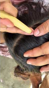 Seru😍OMG LICE #pimple #asmrsounds #satisfying #notalkingasmr #braintingles
