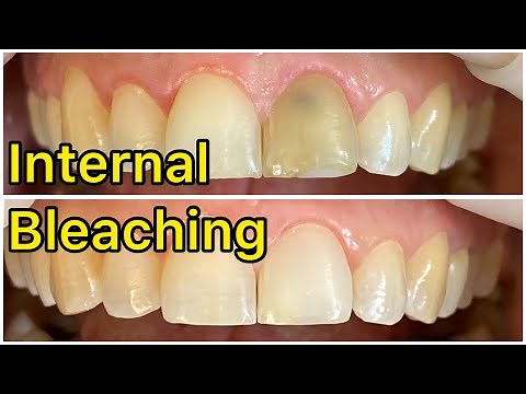 30 years old female / tooth discoloration / internal bleaching / Dr Sara / dentist / Bleaching