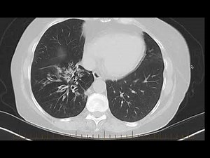 Bronchiectasis with pneumonia