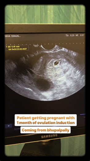 successful treatment of ovulation induction