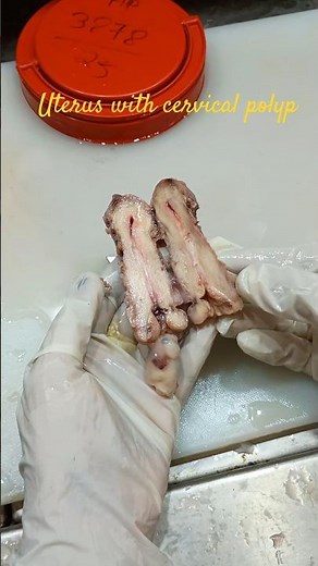 Uterus with cervical polyp specimen 🧐| #histopathology #histomuseum #cervicalcancer #cervicalpolyp