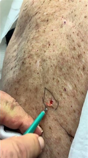 Dr. B uses a curette to remove a seborrheic keratosis #sk #seborrheickeratosis